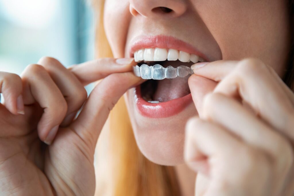 Close-up of a clear aligner being placed over the teeth