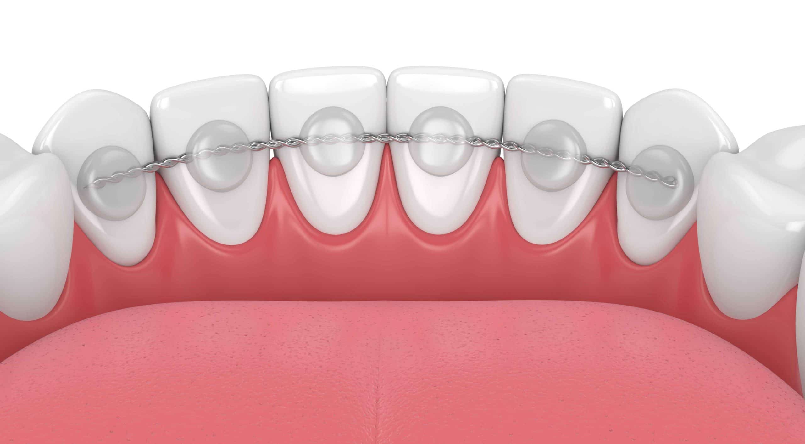 Fixed retainer bonded behind the lower front teeth