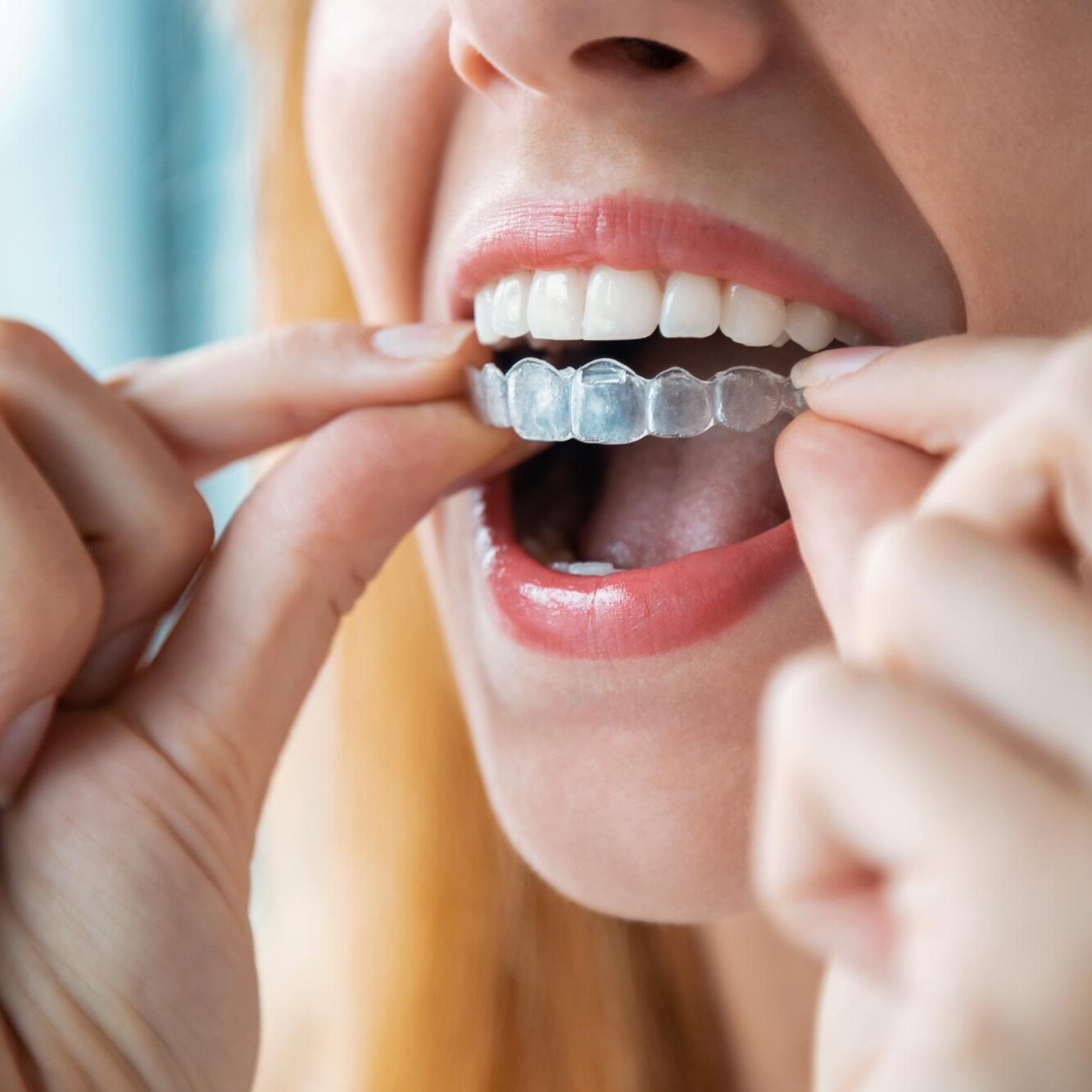 Close-up of a clear aligner being placed over the teeth